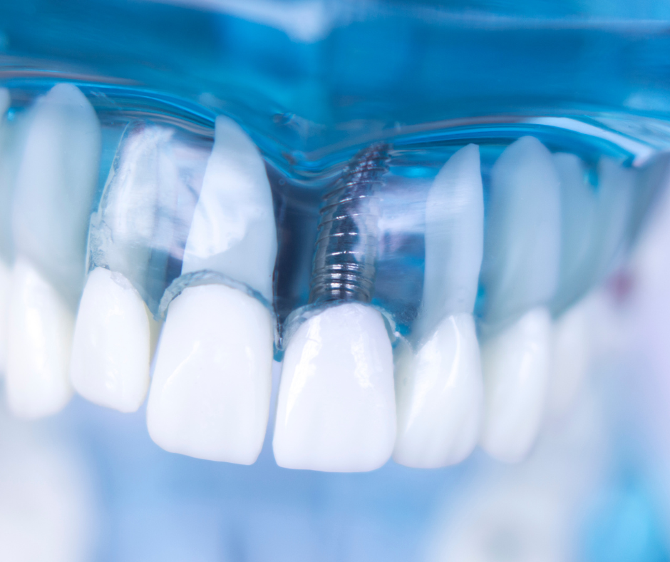 Imagen de un implante dental, una solución moderna y duradera para reemplazar dientes perdidos a un precio accesible.